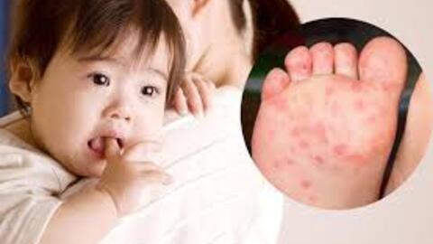 Bệnh tay chân miệng – Dấu hiệu – Các biện pháp phòng tránh