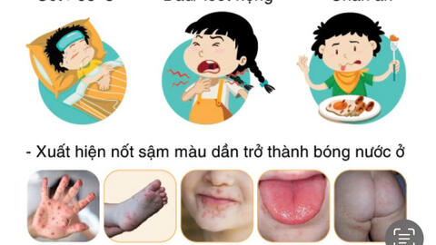 Những điều cần biết để phòng, chống bệnh tay chân miệng