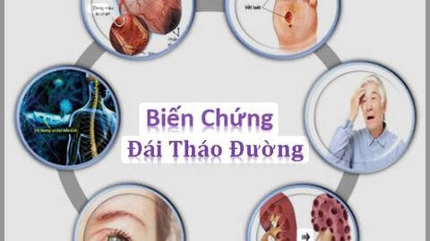 Đái tháo đường tuýp 2: Nguyên nhân, triệu chứng, chẩn đoán và điều trị